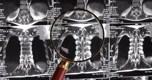 Magnifying Glass Examining Spinal X-Rays
