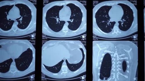 X-ray Scan of Human Lungs