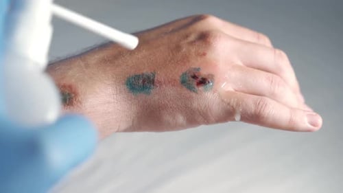 Cleaning Infected Wound on Arm