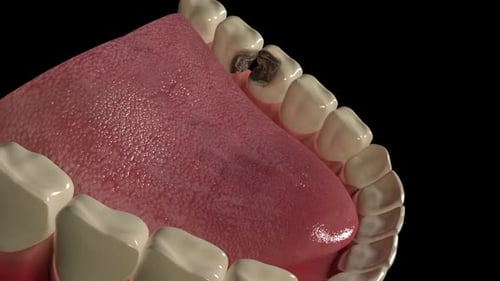 3D Animation of Tooth Decay and Oral Health