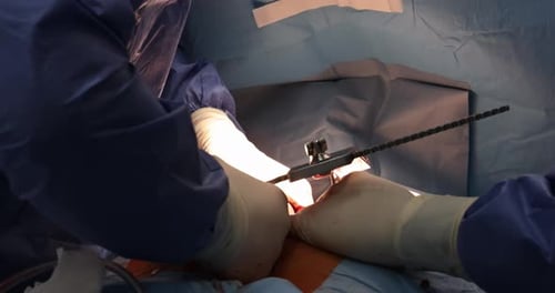 Coronary Artery Bypass Grafting on Open Human Heart Closeup in the Opened Chest During the Surgery