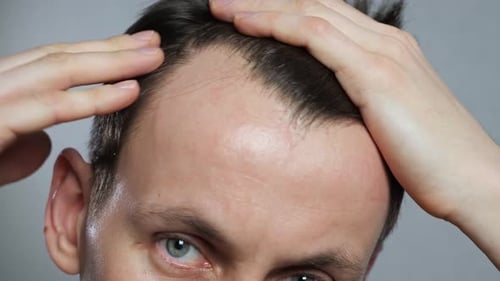 Man Examining Hairline Loss in Close Up