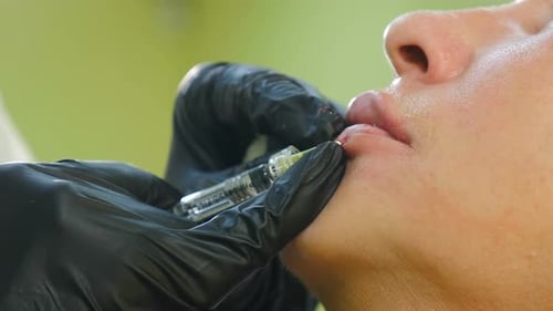 Adult Receives Lip Filler Injections in Clinic