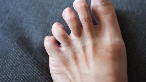 Close Up View of Foot with Toe Sore