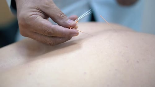 Gros plan sur un homme recevant de l'acupuncture