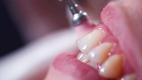 Polishing Teeth in Dental Office