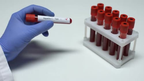 Hepatitis C Blood Test Shows Positive Result