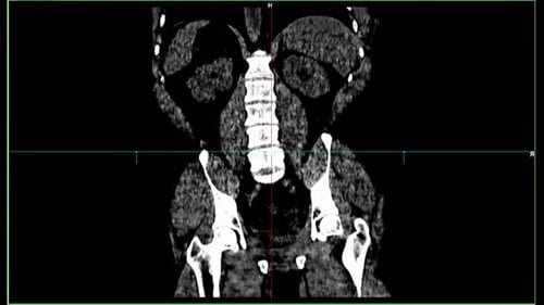 Tomography MRI Diagnosis Data on Laboratory Screen with Human Illness Research in Special Medical