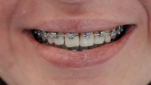 Woman Smiling Showing Silver Braces Close Up