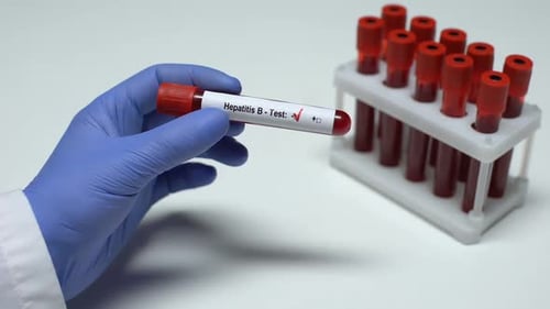 Hepatitis B Positive Blood Sample in Test Tube