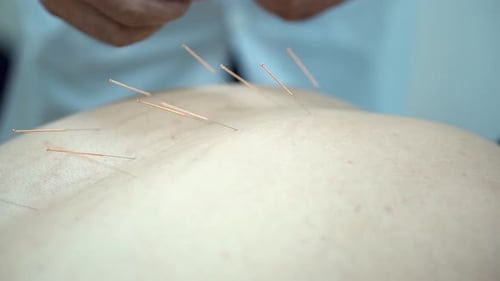 Nahaufnahme eines Mannes, der Akupunktur bekommt