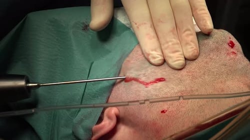 Neck Liposuction For Men 11
