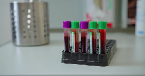 Blood Samples in Test Tubes at the Hospital