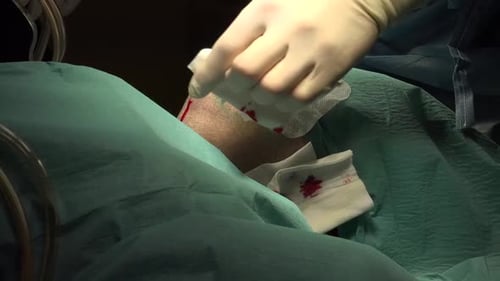 Face and Neck Liposuction for Man 2