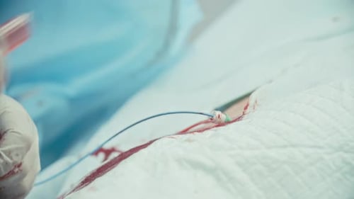 Closeup of Bypass Surgery