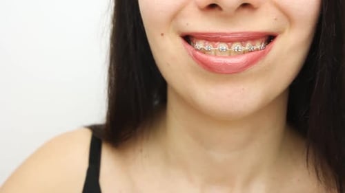 Young Woman Smiling With Braces, Gives Thumbs Up