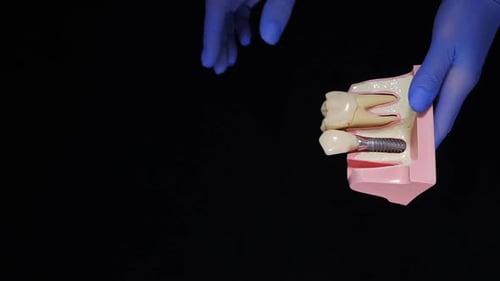 Dental Implant Model Demonstration in Hand