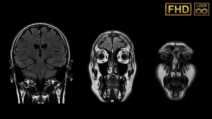 Human Brain Coronal MRI Scan Medical Loop, Interface Effects Motion ...