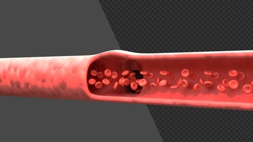 3D Blood Clot Formation and Dissolution in Vein with Red Blood Cells | Alpha Channel