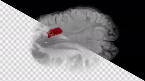 Axial Glioblastoma Frontal Lobe Midline Shift Transparent