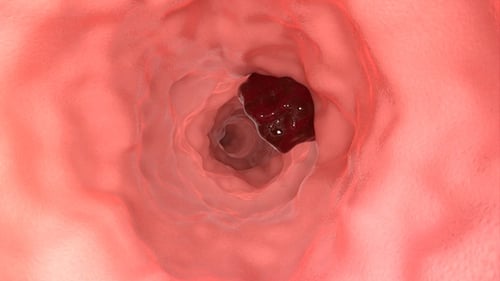 Animación 3D del cáncer de estómago