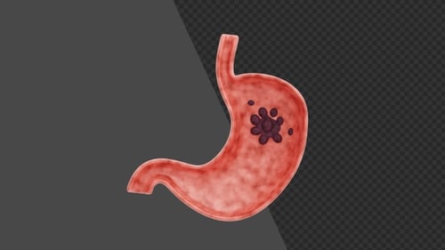 3D Animation of Stomach Cancer Growth Stages in Digestive System | Alpha Channel