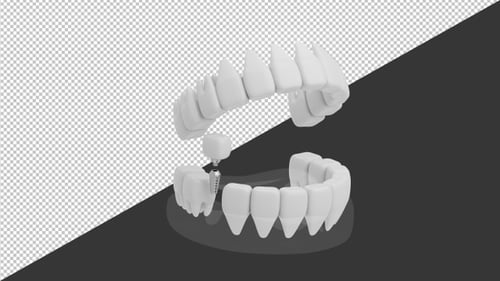 3D Animation of Dental Implant Anatomy Model | Alpha Channel