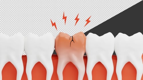 3D Pain in Broken Tooth | Alpha Channel