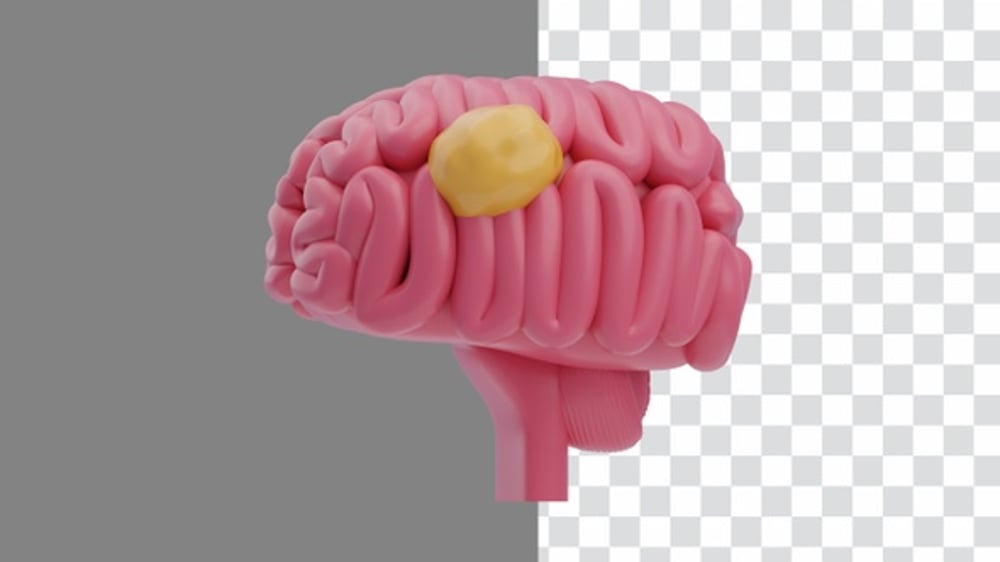 3D Animation of Brain Tumor Pathology | Alpha Channel, Elements Motion ...