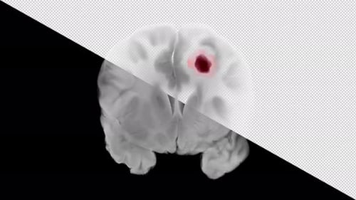 Desarrollo de un tumor de glioblastoma en el hemisferio cerebral izquierdo: vista coronal del cerebro