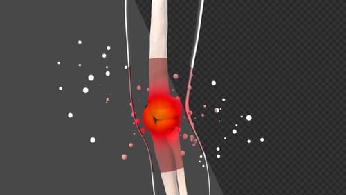 3D Knee Pain Rheumatology Disease | Alpha Channel