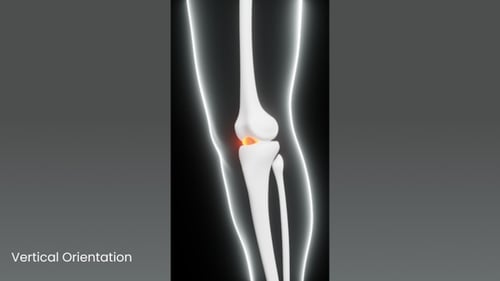 3D Human Knee Joint Pain Medical Animation