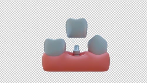3D Dental Implant Assembly Process Animation