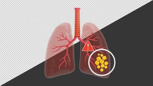 3D Lung Cancer | Alpha Channel
