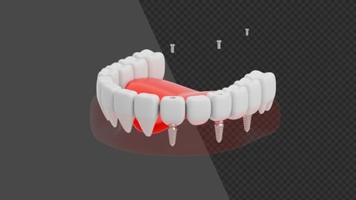 3D Animation of Multiple Dental Implant | Alpha Channel