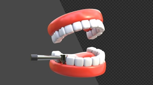 3D Animation of Dental Implant Procedure | Alpha Channel