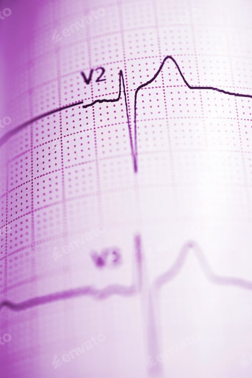Preview: Close Up Of An Electrocardiogram In Paper Form.