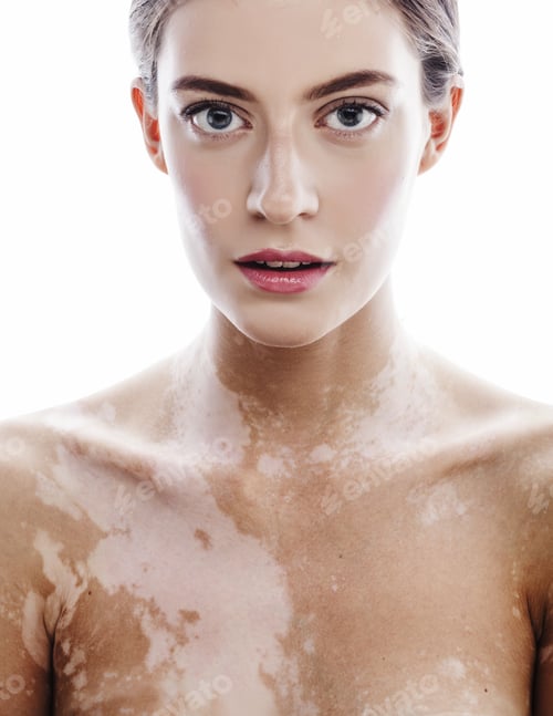 Preview: Beautiful Young Brunette Woman With Vitiligo Disease Close Up Isolated On White