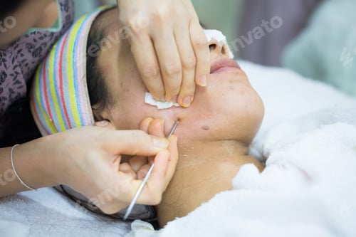 Preview: Beauty Treatment Of Face Skin For Spot Remover In Spa Center. Acne Treament.
