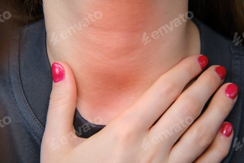 Preview: A Woman Holds Her Hand Over A Red Inflamed Throat, Close-Up. Sore Throat In A Girl With A Cold And