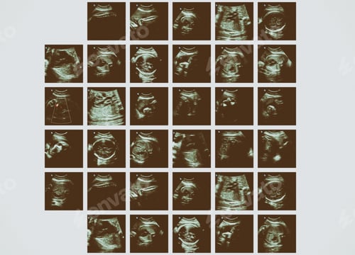 Preview: Series Of Ultrasonography Fetus Images. Pregnancy On 7Th Month.
