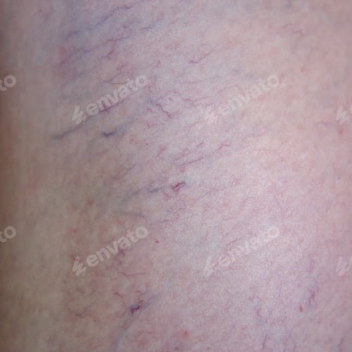 Preview: Woman Leg Close Up With Beginning Varicose Veins