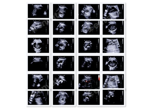 Preview: Series Of Ultrasonography Fetus Images. Pregnancy On 7Th Month.