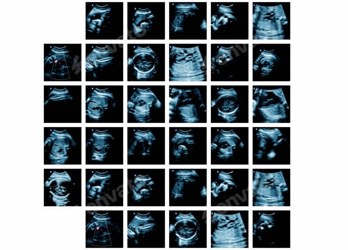 Preview: Series Of Ultrasonography Fetus Images. Pregnancy On 7Th Month.