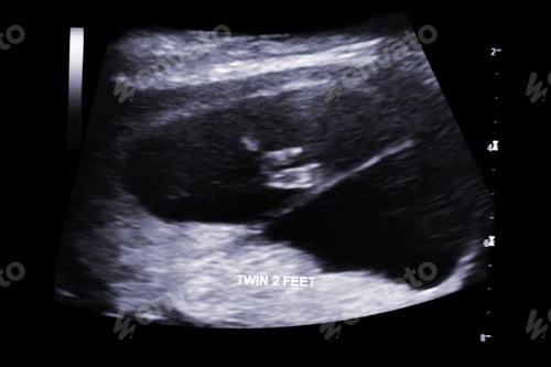 Preview: First Trimester Ultrasound Baby Xray Of Fraternal Twin Feet