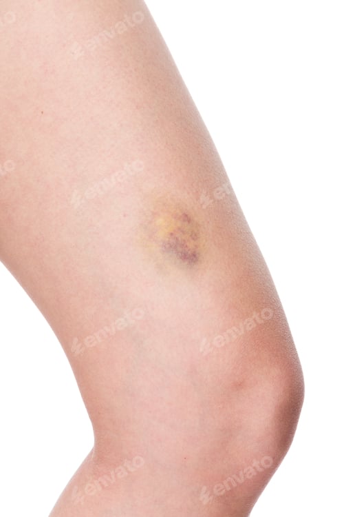 Preview: Bruised Knee