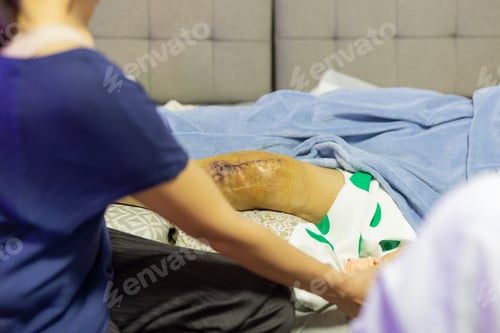 Preview: Doctor Check Senior Woman Patient Scars Surgical Knee Joint Replacement.