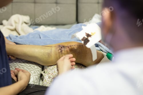 Preview: Metal Staples Used To Stitch Up Skin In Knee Replacement Operation.