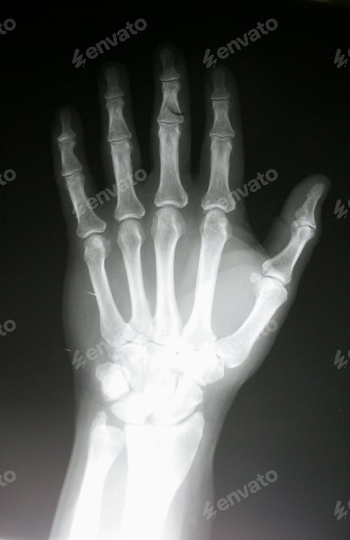 Preview: X-Ray Of A Hand