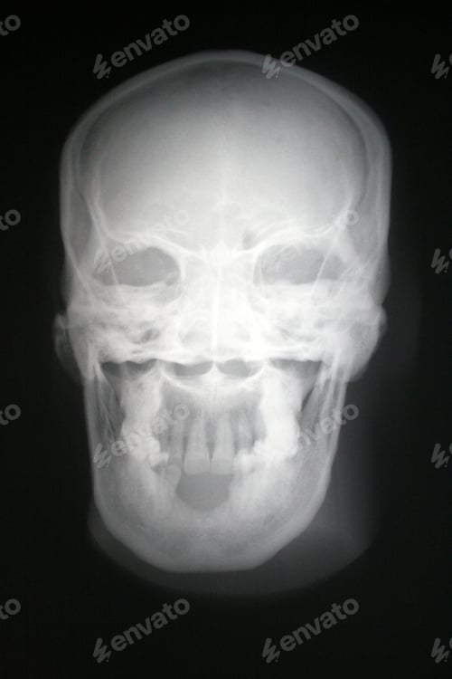 Preview: X-Ray Of A Skull Phantom